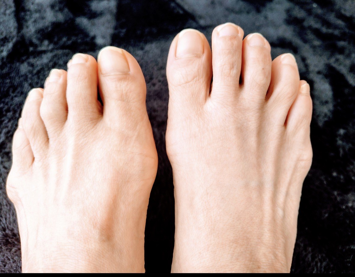 50代の足。外反母趾ぎみで親指の付け根が広がっている